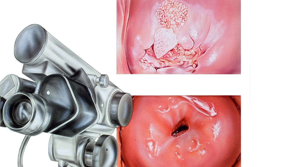 Colposcopia