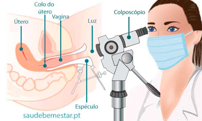 Patologia do Trato Genital Inferior e Colposcopia