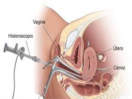 Histeroscopia