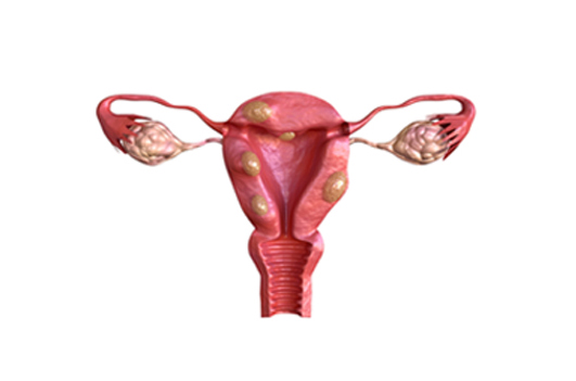 Pólipo e Miomas