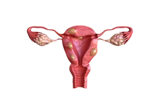Pólipo e Miomas