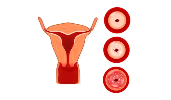 Tratamento a laser HPV