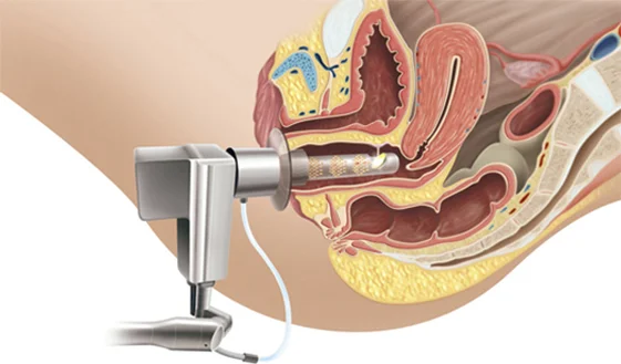 Tratamento de Incontinência urinária a laser