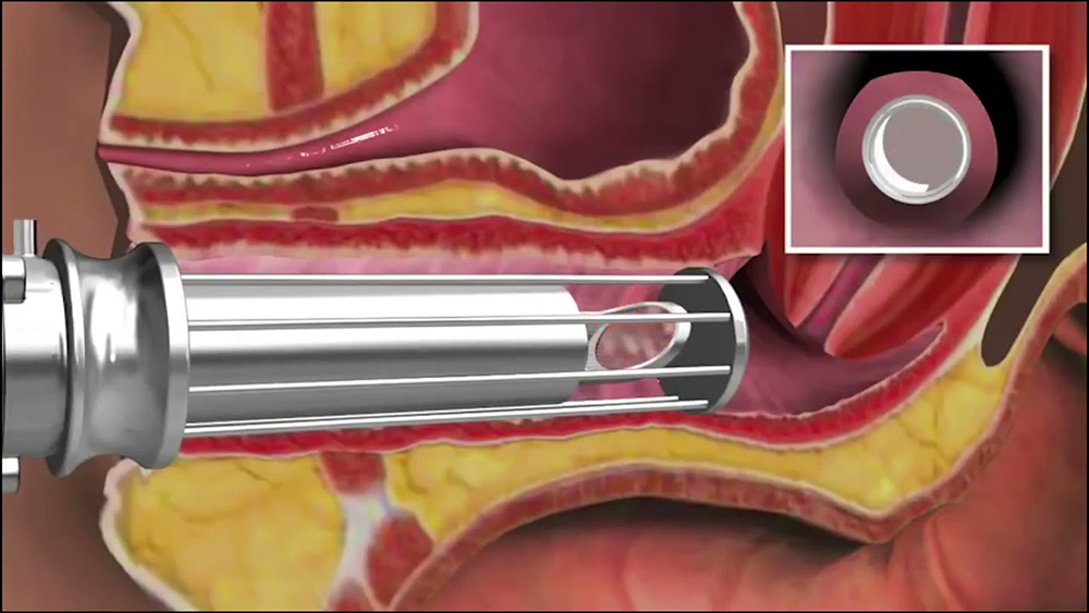 Tratamento a laser para líquen