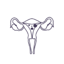 Miomectomia