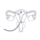 Polipectomia