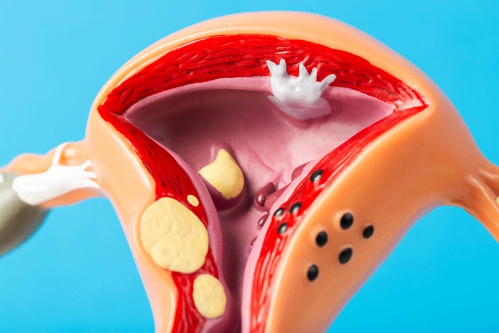 Pólipos uterinos: diagnóstico e tratamentos?